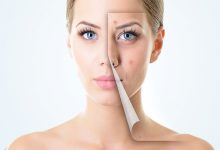 درمان جوش صورت به روش طبیعی