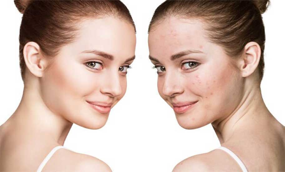 روش های طبیعی درمان جوش صورت