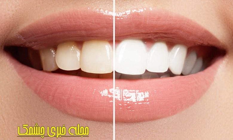 روش های خانگی برای سفید کردن دندان ها