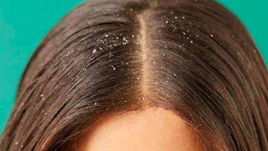 درمان شوره سر