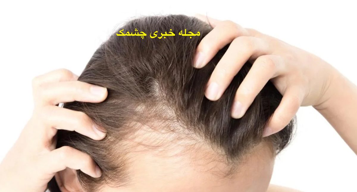 بهترین روش‌ جلوگیری از ریزش مو