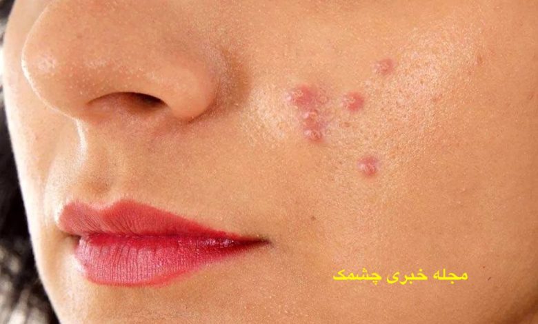 جوش های تابستانی صورت