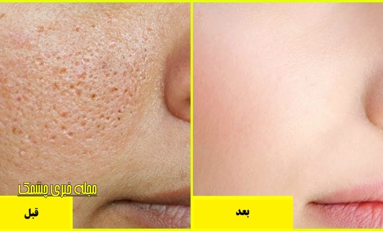 ماسک های طبیعی برای بستن منافذ پوست