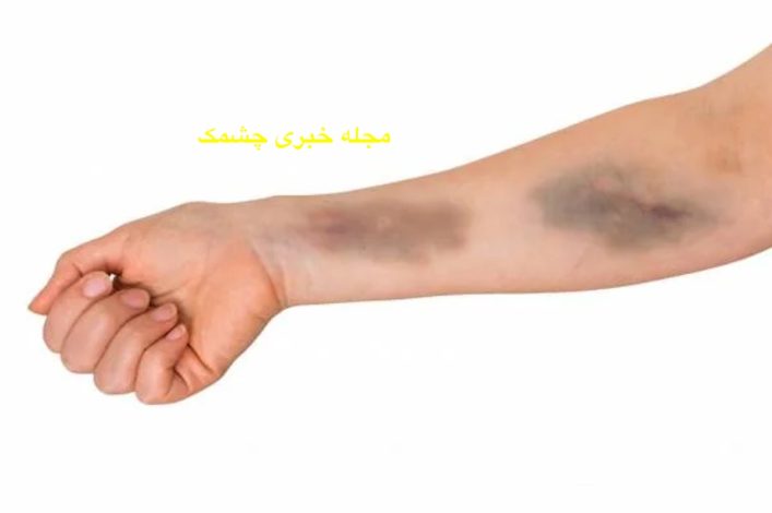 معنای هر رنگ کبودی روی بدن