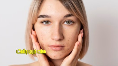 درمان خانگی لکه های تیره صورت