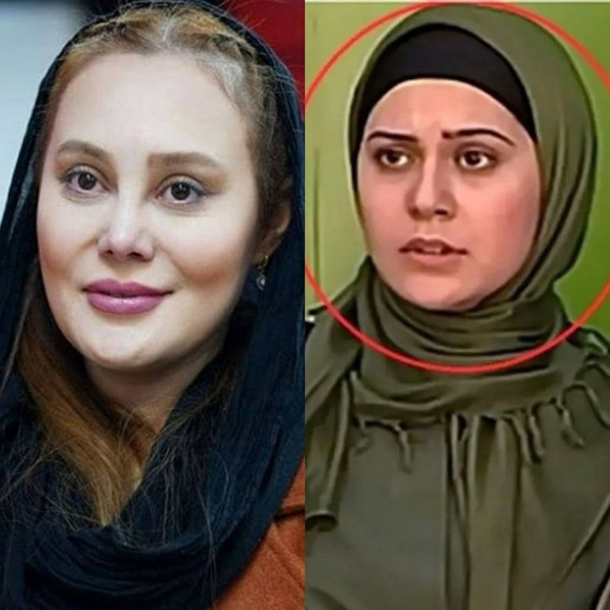 آرام جعفری قبل از عمل زیبایی