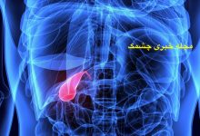 غذاهای مضر برای سنگ کیسه صفرا