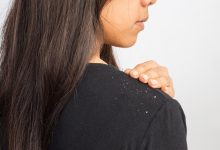 درمان شوره سر در خانه