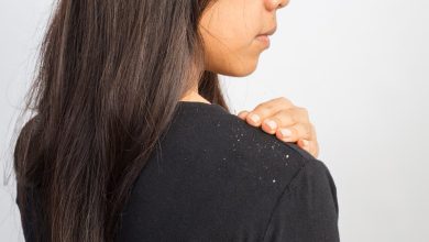 درمان شوره سر در خانه